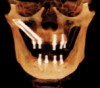 Fig 12. Representative examples of the use of zygomatic implants for rehabilitation of the severely resorbed maxilla. Fig 10:
Zygomatic implants placed for posterior prostheses support in the absence of sufficient bone in zones 1 and 2 are combined with conventional anterior
implants. Fig 11: Quad zygomatic implants are placed for support of the maxillary prosthesis in the absence of sufficient bone in zones 1, 2, and
3. Fig 12: The unilateral absence of bone in zones 1, 2, and 3 is addressed using unilateral quad zygomatic and conventional implants contralaterally.