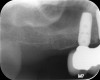 Fig 14. Short implants used to avoid grafting. Fig 13: Occlusal view of a full-arch fixed dental prosthesis supported by five endosseous
implants placed. Fig 14: The left distal implant was tilted to support the left molar unit of the prosthesis. Fig 15: A 6 mm x 5.4 mm implant
was used to support the right molar unit of the prosthesis. The strategic application of nongrafted solutions helped accelerate treatment and
reduce treatment costs.