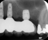 Fig 15. Short implants used to avoid grafting. Fig 13: Occlusal view of a full-arch fixed dental prosthesis supported by five endosseous
implants placed. Fig 14: The left distal implant was tilted to support the left molar unit of the prosthesis. Fig 15: A 6 mm x 5.4 mm implant
was used to support the right molar unit of the prosthesis. The strategic application of nongrafted solutions helped accelerate treatment and
reduce treatment costs.