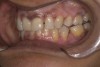 Fig 8. Posterior teeth out of occlusion due to palatal build-up.
