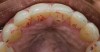 Fig 14. Postoperative view showing additively restored palatal surfaces of upper anteriors.