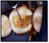 Fig 1. Self-etch: minimum treatment time with reduced risk of postoperative sensitivity.