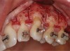 Fig 2. An envelope flap with a papilla-sparing incision design, leaving the interproximal tissue intact.