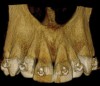 Fig 3 through Fig 8. SFOT used to achieve expansion and decrowding. Fig 3: CBCT, front view, preoperative. Fig 4: CBCT, sagittal view, preoperative. Fig 5: Clinical photograph, preoperative. Fig 6: CBCT, front view, postoperative. Fig 7: CBCT, sagittal view, postoperative. Note the new bone generation mostly at the apical portion. Fig 8: Clinical photograph, postoperative. Note the improved and more coronal positioning of gingival margins with a stable and robust clinical outcome.