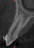 Fig 3 through Fig 8. SFOT used to achieve expansion and decrowding. Fig 3: CBCT, front view, preoperative. Fig 4: CBCT, sagittal view, preoperative. Fig 5: Clinical photograph, preoperative. Fig 6: CBCT, front view, postoperative. Fig 7: CBCT, sagittal view, postoperative. Note the new bone generation mostly at the apical portion. Fig 8: Clinical photograph, postoperative. Note the improved and more coronal positioning of gingival margins with a stable and robust clinical outcome.