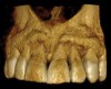 Fig 3 through Fig 8. SFOT used to achieve expansion and decrowding. Fig 3: CBCT, front view, preoperative. Fig 4: CBCT, sagittal view, preoperative. Fig 5: Clinical photograph, preoperative. Fig 6: CBCT, front view, postoperative. Fig 7: CBCT, sagittal view, postoperative. Note the new bone generation mostly at the apical portion. Fig 8: Clinical photograph, postoperative. Note the improved and more coronal positioning of gingival margins with a stable and robust clinical outcome.