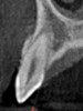 Fig 3 through Fig 8. SFOT used to achieve expansion and decrowding. Fig 3: CBCT, front view, preoperative. Fig 4: CBCT, sagittal view, preoperative. Fig 5: Clinical photograph, preoperative. Fig 6: CBCT, front view, postoperative. Fig 7: CBCT, sagittal view, postoperative. Note the new bone generation mostly at the apical portion. Fig 8: Clinical photograph, postoperative. Note the improved and more coronal positioning of gingival margins with a stable and robust clinical outcome.