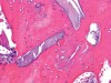 Fig 9. Histology slide 1-year post-SFOT showing deproteinized bovine bone mineral incorporated within newly formed bone.