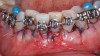 Fig 10 through Fig 13. ADM used as a membrane. Fig 10: Intraoperative photograph. Fig 11: Note the added thickness at the time of closure. Fig 12: Note tissue sloughing around teeth Nos. 24 and 25. Fig 13: Due to tissue sloughing, outcome was compromised with gingival recession and reduced tissue thickness.