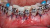 Fig 10 through Fig 13. ADM used as a membrane. Fig 10: Intraoperative photograph. Fig 11: Note the added thickness at the time of closure. Fig 12: Note tissue sloughing around teeth Nos. 24 and 25. Fig 13: Due to tissue sloughing, outcome was compromised with gingival recession and reduced tissue thickness.