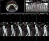 Fig 14 and Fig 15. SFOT performed on buccal bone, preoperative (Fig 14) and postoperative (Fig 15) CBCT scans. Note the facial thickness added at the apical third despite the proclination of the decompensated mandibular incisors.