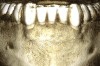 Fig 16 and Fig 17. Another case of SFOT performed on the buccal, preoperative (Fig 16) and postoperative (Fig 17). Note the robust facial thickness 6 months after orthodontic therapy.