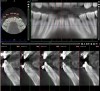 Fig 18 and Fig 19. Preoperative (Fig 18) and postoperative (Fig 19) CBCT scans of the case shown in Fig 16 and Fig 17. The postoperative CBCT was taken following the conclusion of orthodontic therapy, 18 months after SFOT. Note the added volume of bone post-treatment.