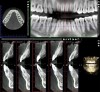 Fig 18 and Fig 19. Preoperative (Fig 18) and postoperative (Fig 19) CBCT scans of the case shown in Fig 16 and Fig 17. The postoperative CBCT was taken following the conclusion of orthodontic therapy, 18 months after SFOT. Note the added volume of bone post-treatment.