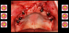 Fig 5. Practitioners must know whether there will be similar errors in a similar direction for a full-arch dental implant.