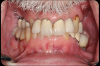 Fig 8. The patient had bite posture problems, caries, periodontal disease, failing restorations and implants, and a history of head-and-neck cancer.