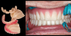 Fig 13. Bad teeth are immediately removed and replaced with good temporary teeth.