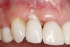 Fig 1. Clinical photograph showing significant issues related to implant midfacial mucosal recession and loss of interdental papillae. This is attributed to incorrect implant positioning (too buccal and too deep); several corrective surgeries resulted in interproximal bone loss, then loss of interdental papillae.