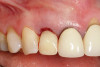 Fig 8. Immediate provisionalization was fabricated to preserve the soft-tissue contour to prevent midfacial implant mucosal recession.