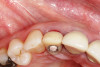 Fig 9. Occlusal view showing excellent soft-tissue contour.