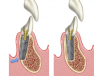 Fig 8. Reverse rotation application in the anterior mandible to avoid apical perforation (arrow) of the floor of the mouth.