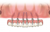 Fig 9. Dual-axial maxillary implant solutions to mitigate need for sinus augmentation and onlay grafts.