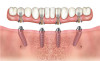 Fig 10. Dual-axial mandibular implant solutions to avoid inferior alveolar nerve injury.