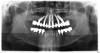 Fig 11. Panorex of clinical application of dual-axis principles. From left to right: 36-degree tooth No. 4; 24-degree tooth No. 6; 12-degree tooth No. 8; 12-degree tooth No. 9; 24-degree tooth No. 11; and 36-degree tooth No. 13. Angulation is designed to avoid maxillary sinus and buccal constraints of the anterior maxilla. (Image courtesy of Costa Nicolopoulos, BDS, Dubai, United Arab Emirates)
