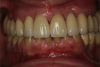 Fig 12. Frontal view (Fig 12) and occlusal view (Fig 13) of clinical application of dual-axis principles. (Images courtesy of Costa Nicolopoulos, BDS)