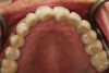 Fig 13. Frontal view (Fig 12) and occlusal view (Fig 13) of clinical application of dual-axis principles. (Images courtesy of Costa Nicolopoulos, BDS)