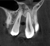 Fig 3. Tomographic images revealed a tridimensional defect extending to the apical third of teeth Nos. 6 and 8, a buccal bone dehiscence on tooth No. 5, and associated thin labial plates.