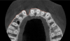 Fig 4. Tomographic images revealed a tridimensional defect extending to the apical third of teeth Nos. 6 and 8, a buccal bone dehiscence on tooth No. 5, and associated thin labial plates.
