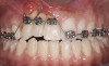 Fig 5. Start of orthodontic forced eruption to develop sites Nos. 6 and 8 before implant placement. A denture tooth was common-tied to the archwire to serve as a pontic. Anchorage requirements determined the extent of bracket placement.