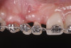 Fig 8. Compared to the preoperative view seen in Fig 2, adequate alveolar height and gingival profile were achieved with forced eruption (Fig 8). Direct composite splint would remain for 3 months. Residual cleft was a visible remnant of iatrogenic defect. Post-orthodontically, keratinization of sulcular epithelium on tooth No. 8 was evident (Fig 9).