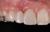 Fig 9. Compared to the preoperative view seen in Fig 2, adequate alveolar height and gingival profile were achieved with forced eruption (Fig 8). Direct composite splint would remain for 3 months. Residual cleft was a visible remnant of iatrogenic defect. Post-orthodontically, keratinization of sulcular epithelium on tooth No. 8 was evident (Fig 9).