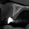 Fig 11. Tomographic images of teeth Nos. 6 (Fig 10), 7 (Fig 11), and 8 (Fig 12) clearly showed vertical gains in alveolar height, including in the edentulous area corresponding to tooth No. 7. The apex of tooth No. 8 was located within the soft tissue because it was force-erupted beyond its socket.