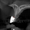 Fig 12. Tomographic images of teeth Nos. 6 (Fig 10), 7 (Fig 11), and 8 (Fig 12) clearly showed vertical gains in alveolar height, including in the edentulous area corresponding to tooth No. 7. The apex of tooth No. 8 was located within the soft tissue because it was force-erupted beyond its socket.
