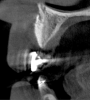Fig 14. Flapless horizontal bone augmentation in the areas of teeth Nos. 6 (Fig 13), 7 (Fig 14), and 8 (Fig 15), using SMART method.