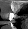 Fig 15. Flapless horizontal bone augmentation in the areas of teeth Nos. 6 (Fig 13), 7 (Fig 14), and 8 (Fig 15), using SMART method.