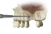 Fig 17. Illustration of SMART method. A full-thickness incision is made at a remote location, and a subperiosteal tunnel is developed to provide laparoscopic access to the site (Fig 17). A subperiosteal pouch is then created to confine the graft without damaging the periosteum (Fig 18).