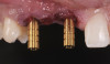 Fig 19. After extraction of teeth Nos. 6 and 8, implants were placed and a screw-retained immediate three-unit provisional was delivered.