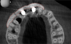 Fig 21. After extraction of teeth Nos. 6 and 8, implants were placed and a screw-retained immediate three-unit provisional was delivered.