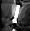 Fig 22. The implants selected for teeth Nos. 6 (Fig 22) and 8 (Fig 23) featured a tapered design.