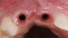 Fig 25. Three months post-treatment, peri-implant soft tissues appeared healthy.