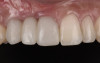 Fig 26 . Three months post-treatment, favorable gingival architecture was preserved.