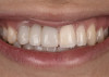 Fig 27. Three months post-treatment, favorable gingival architecture was preserved.
