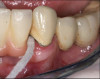 Fig 8. use of gauze at the interdental space.
