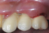 Fig 9. Treatment of peri-implant mucositis: plaque accumulation and mucosal inflammation.