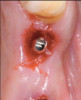 Fig 10. Traumatic impingement of the pontic on the peri-implant mucosa.
