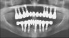 Fig 13. Radiograph depicting crestal bone loss around mandibular implants.